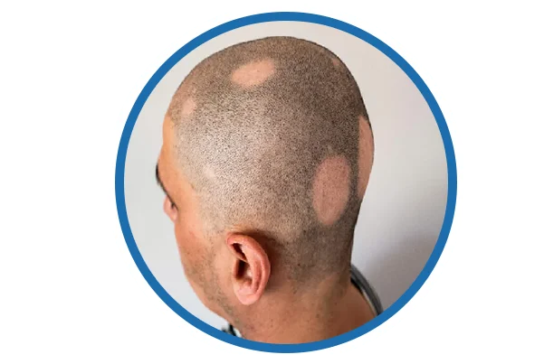 Alopecia Areata