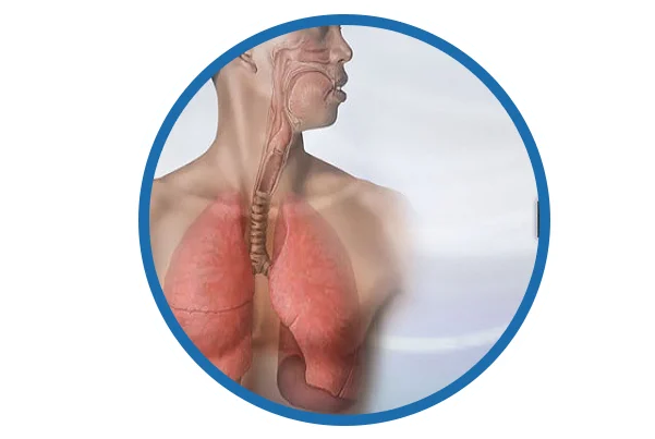 Bronchitis