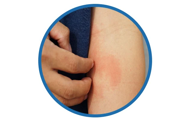 Eczema