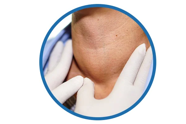 Hypothyroidism