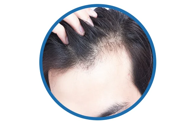 Hair Loss