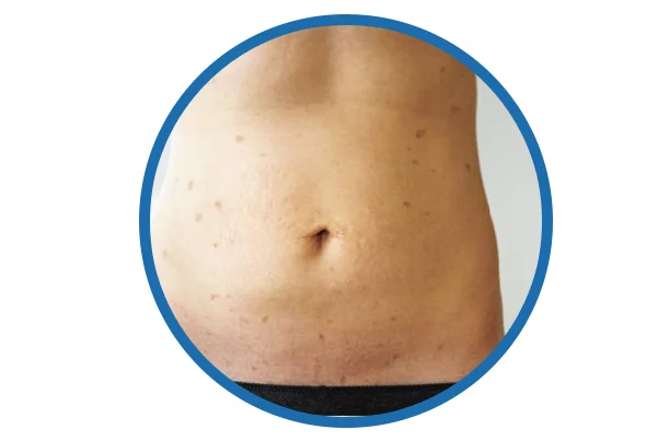 Lichen Planus