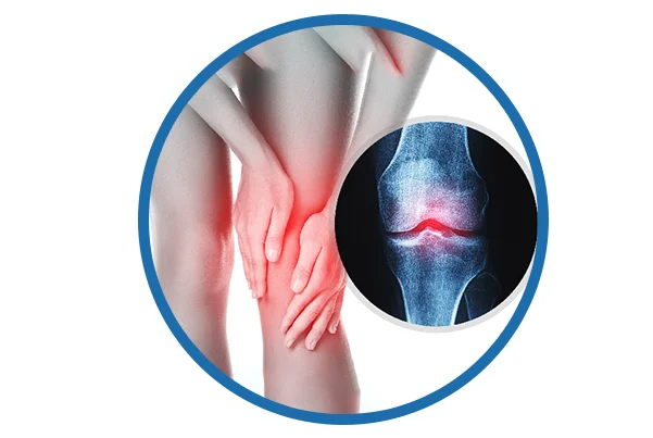 Osteoarthritis
