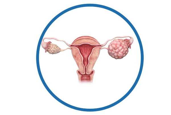 PCOD and PCOS