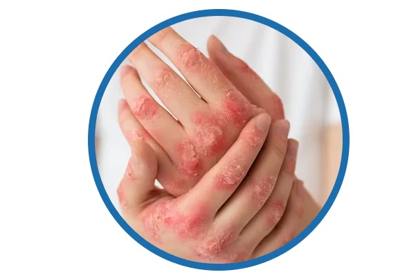 Psoriasis