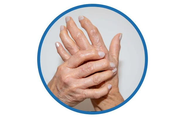 Rheumatoid Arthritis