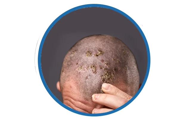 Scalp Psoriasis